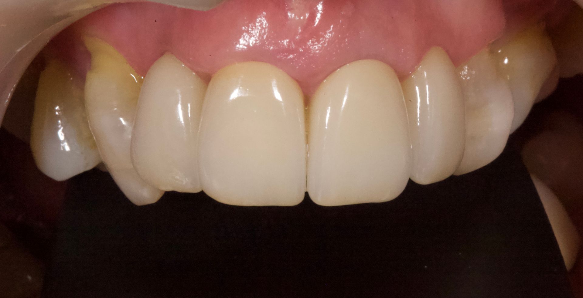 Close-up of a mouth showing upper front teeth and pink gums with a dental appliance.