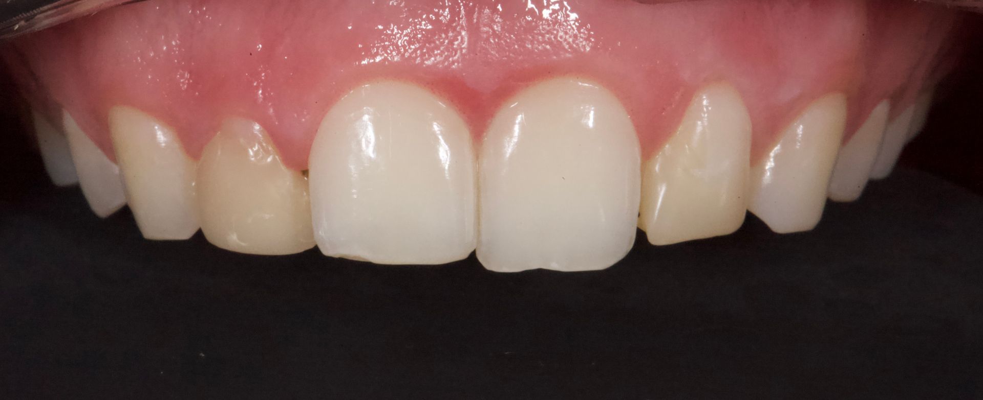 Close-up of a smiling mouth with visible upper teeth and pink gums