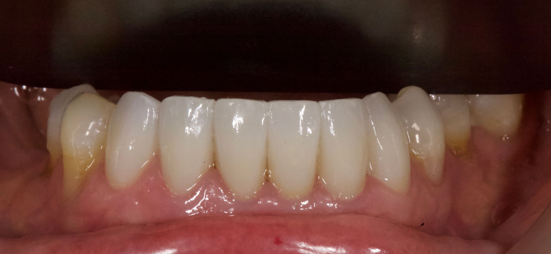 Close-up of teeth with a yellow stain on one front tooth against pink gums.