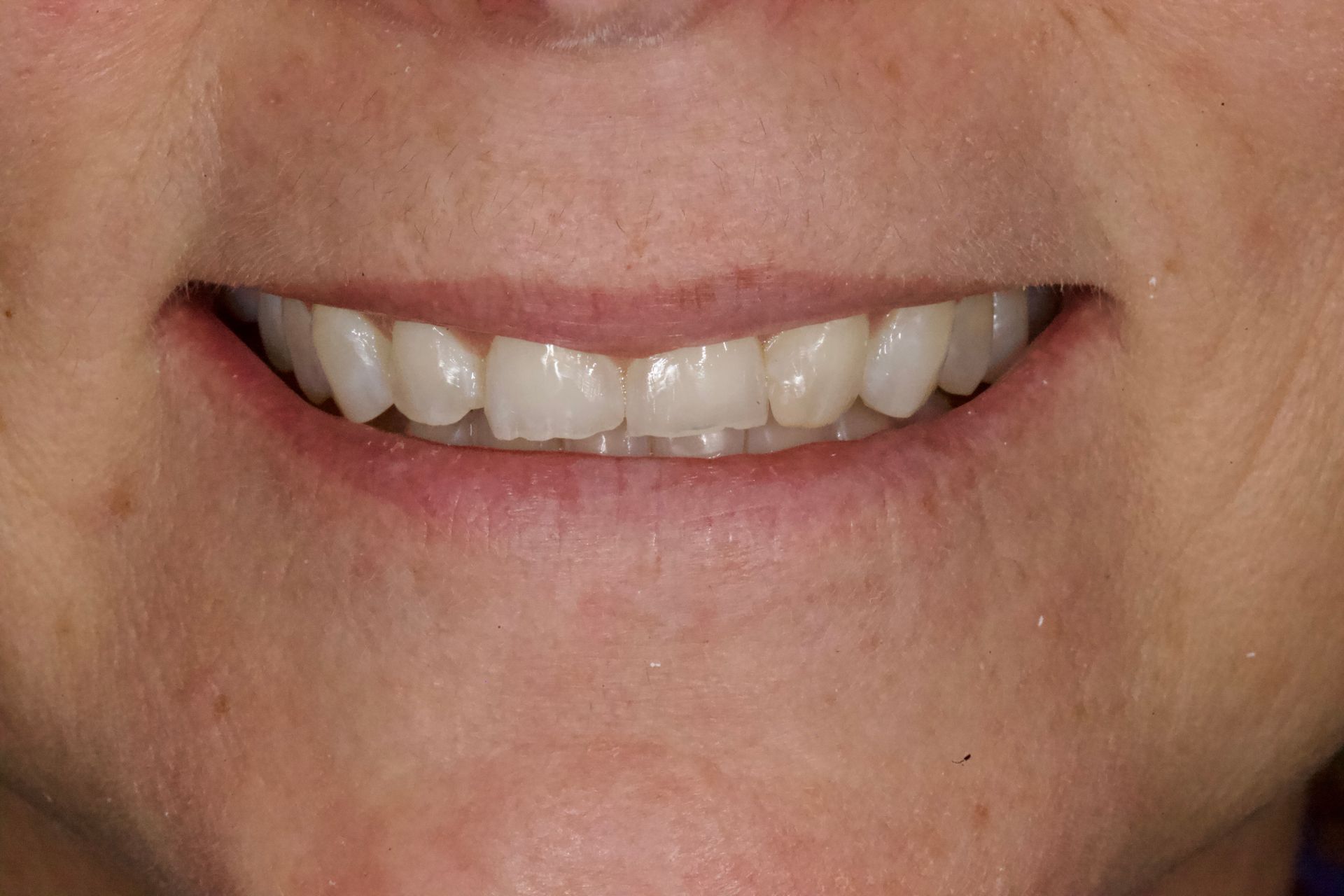 Close-up of a smiling mouth showing white teeth and lips