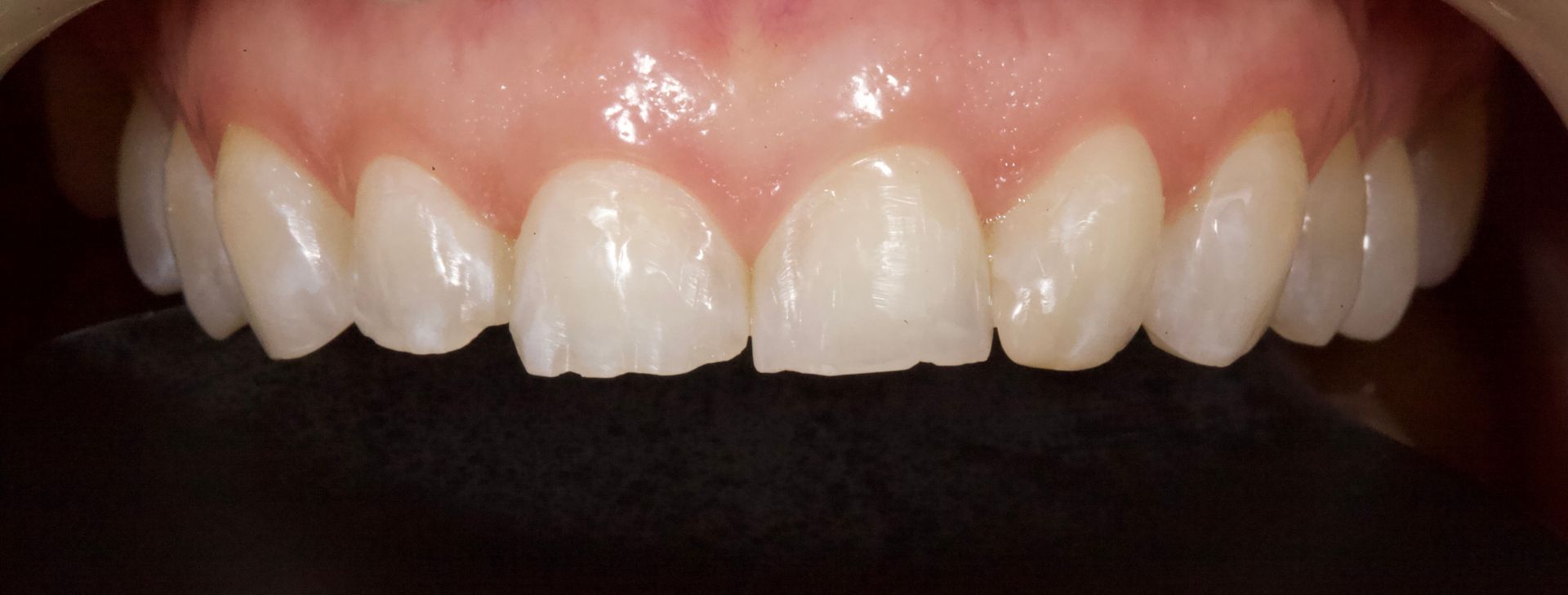 Close-up of a person’s front teeth and gums, showing slight crowding and natural enamel color.