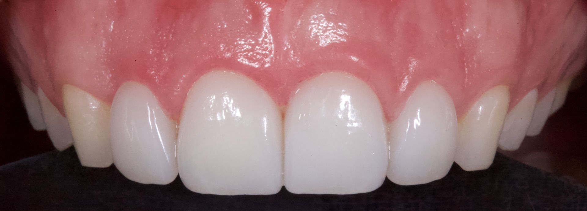 Close-up of upper front teeth and gums, showing white teeth and pink gums