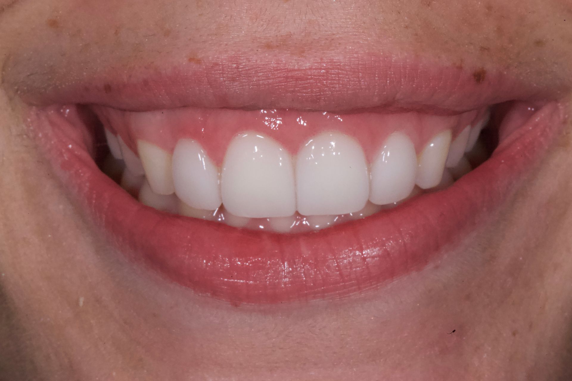 Close-up of a smiling mouth with white teeth and pink lips