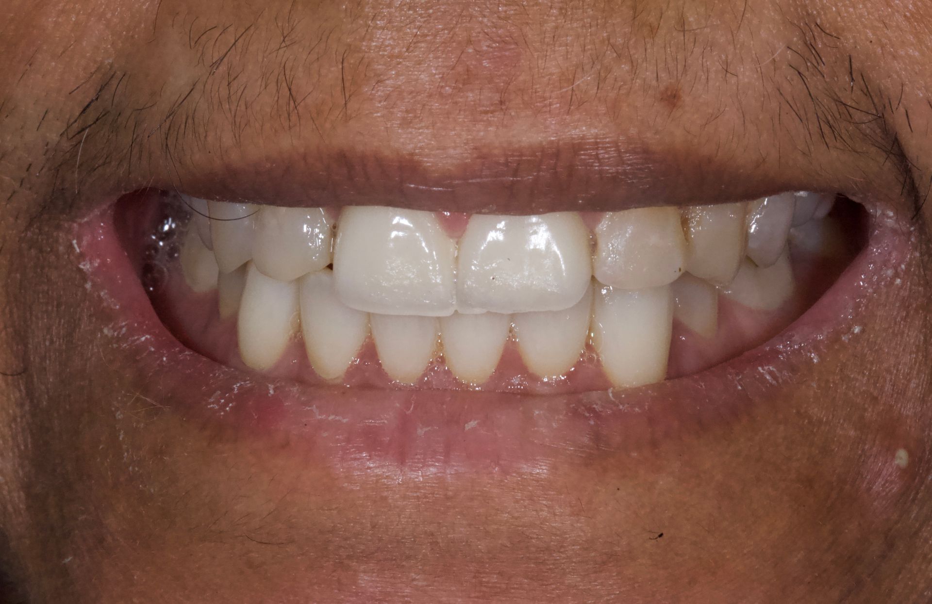 Close-up of a smiling mouth showing teeth and gums