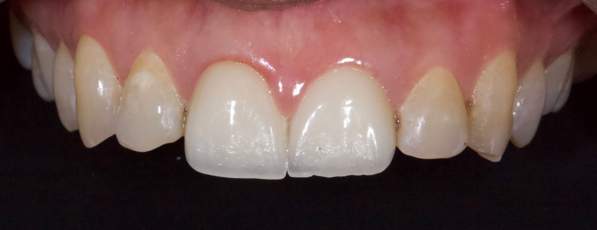 Close-up of upper front teeth with a chipped and stained smile
