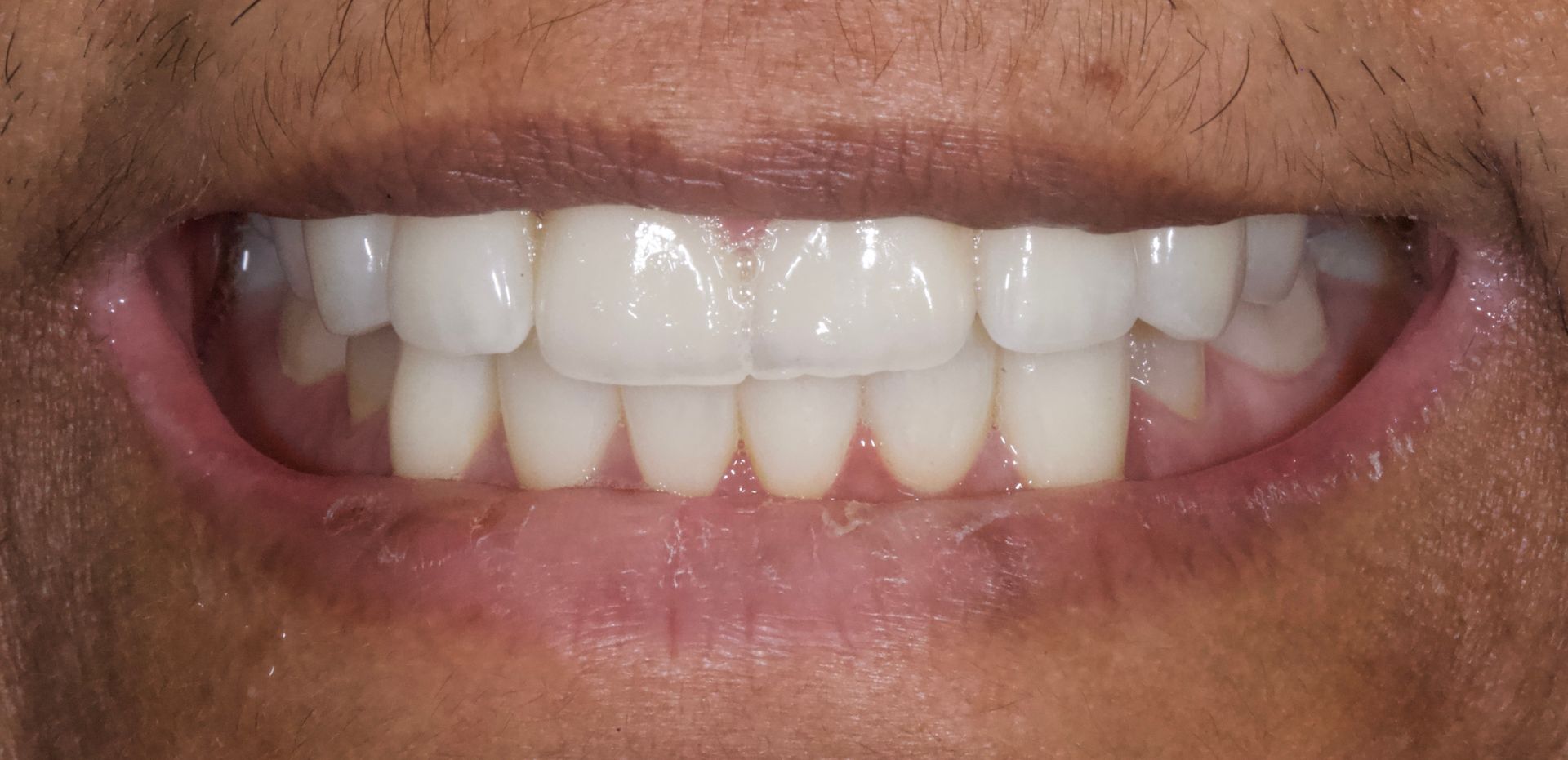 Close-up of a smiling mouth with white teeth and pink lips