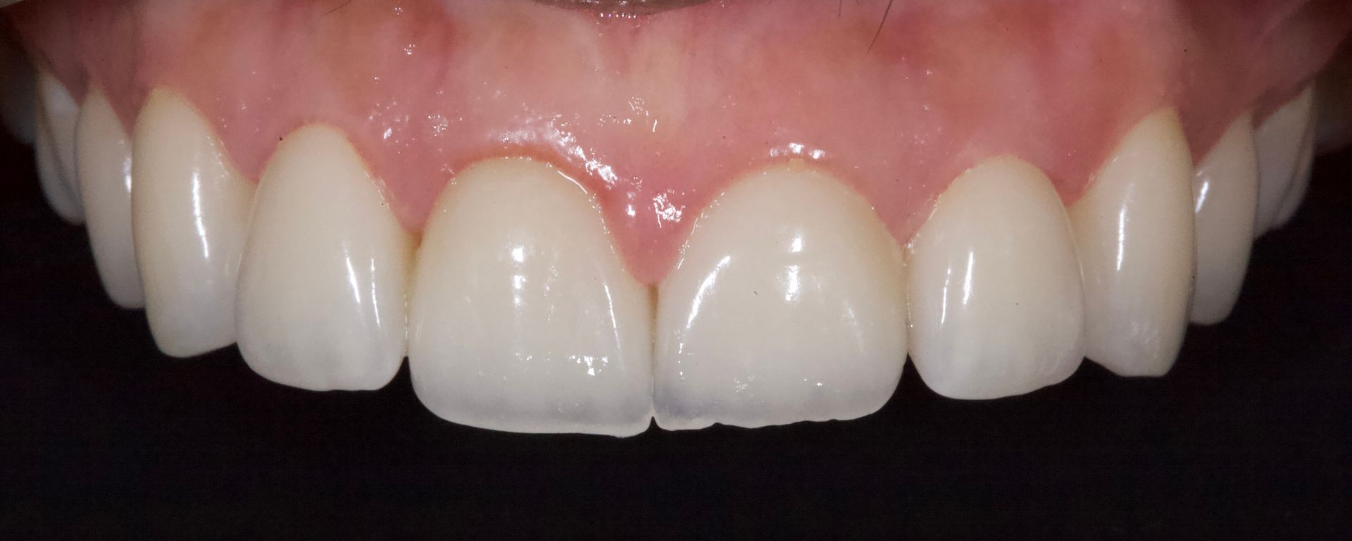 Close-up of smiling mouth showing white upper front teeth and pink gums