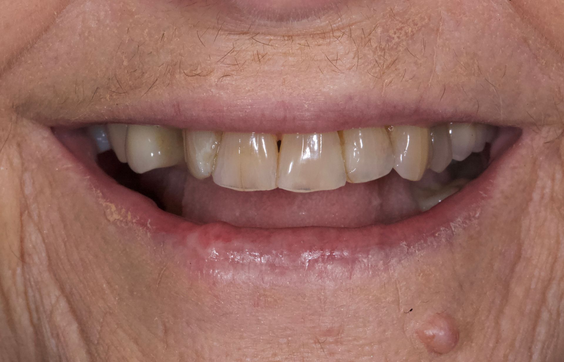 Close-up of a smiling mouth with visible teeth and a small pimple on the chin
