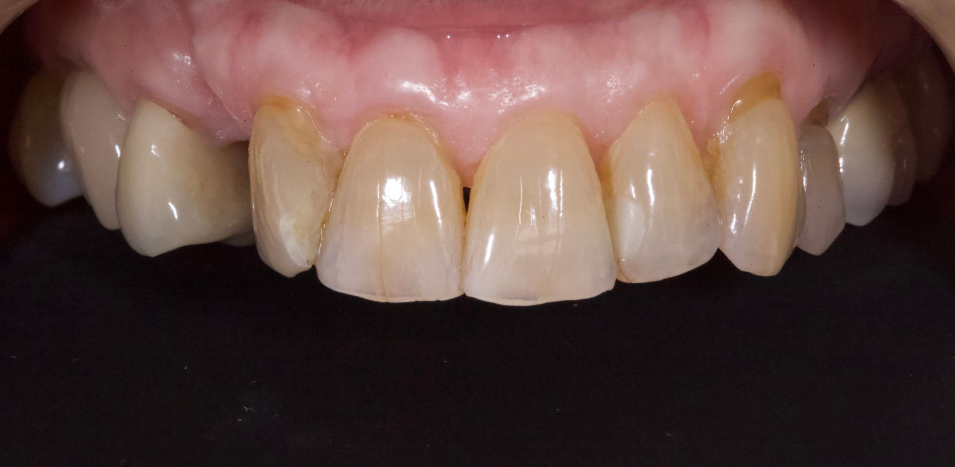 Close-up of upper front teeth with yellow staining and visible plaque near the gums