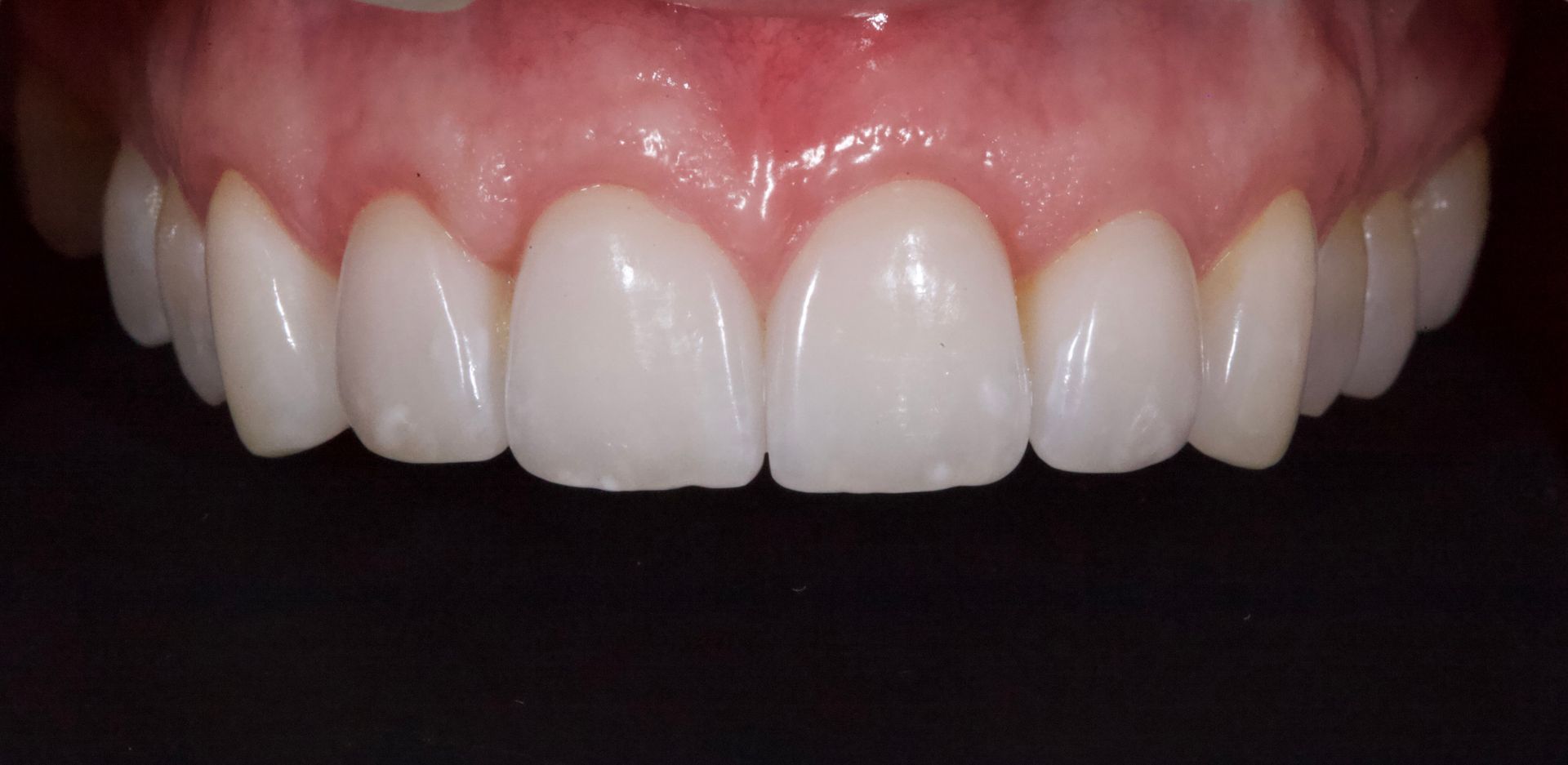 Close-up of a smiling mouth showing bright white teeth and pink gums