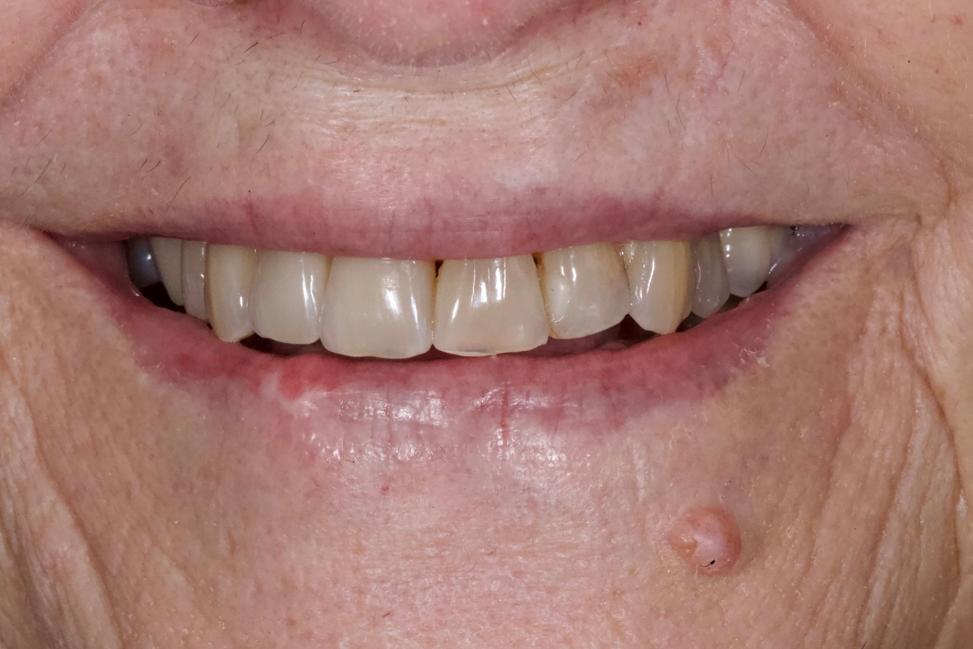 Close-up of a smiling mouth showing teeth and a small bump on the lower right chin