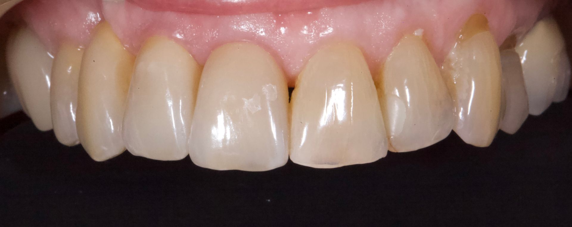 Close-up of upper front teeth with pink gums, showing slight discoloration and wear