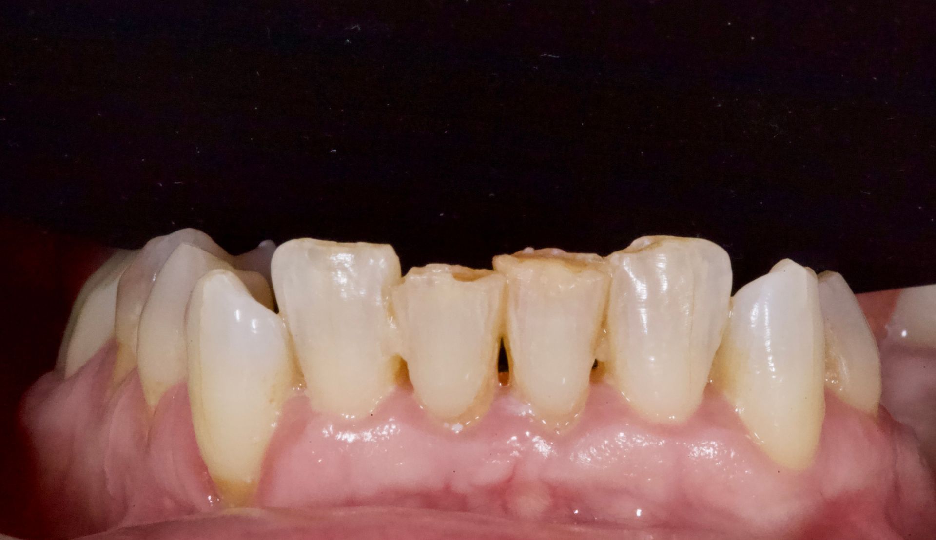 Close-up of lower front teeth with noticeable yellowing and gaps, shown against a dark background