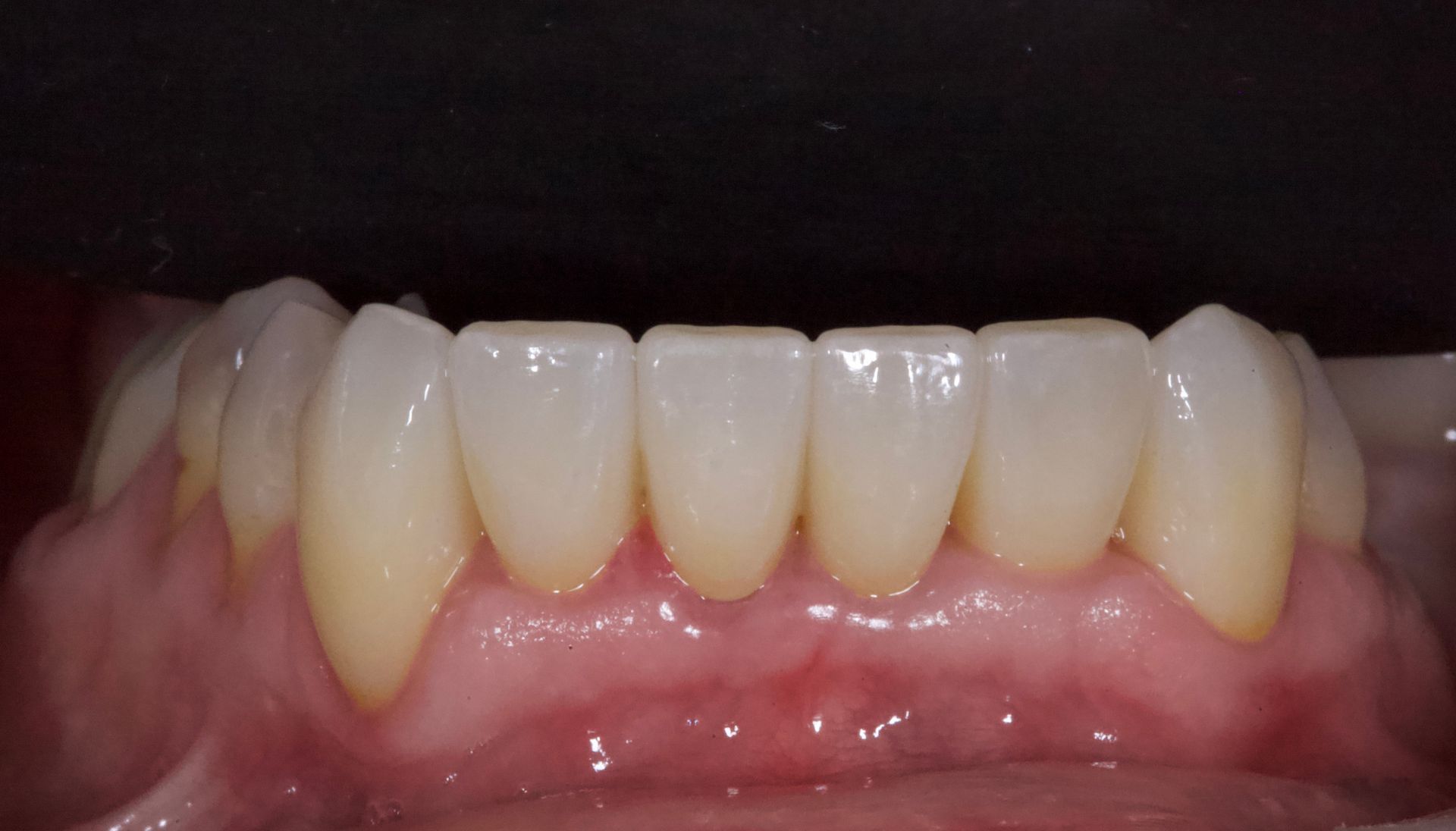 Close-up of lower front teeth with pink gums and visible spacing, against a dark background