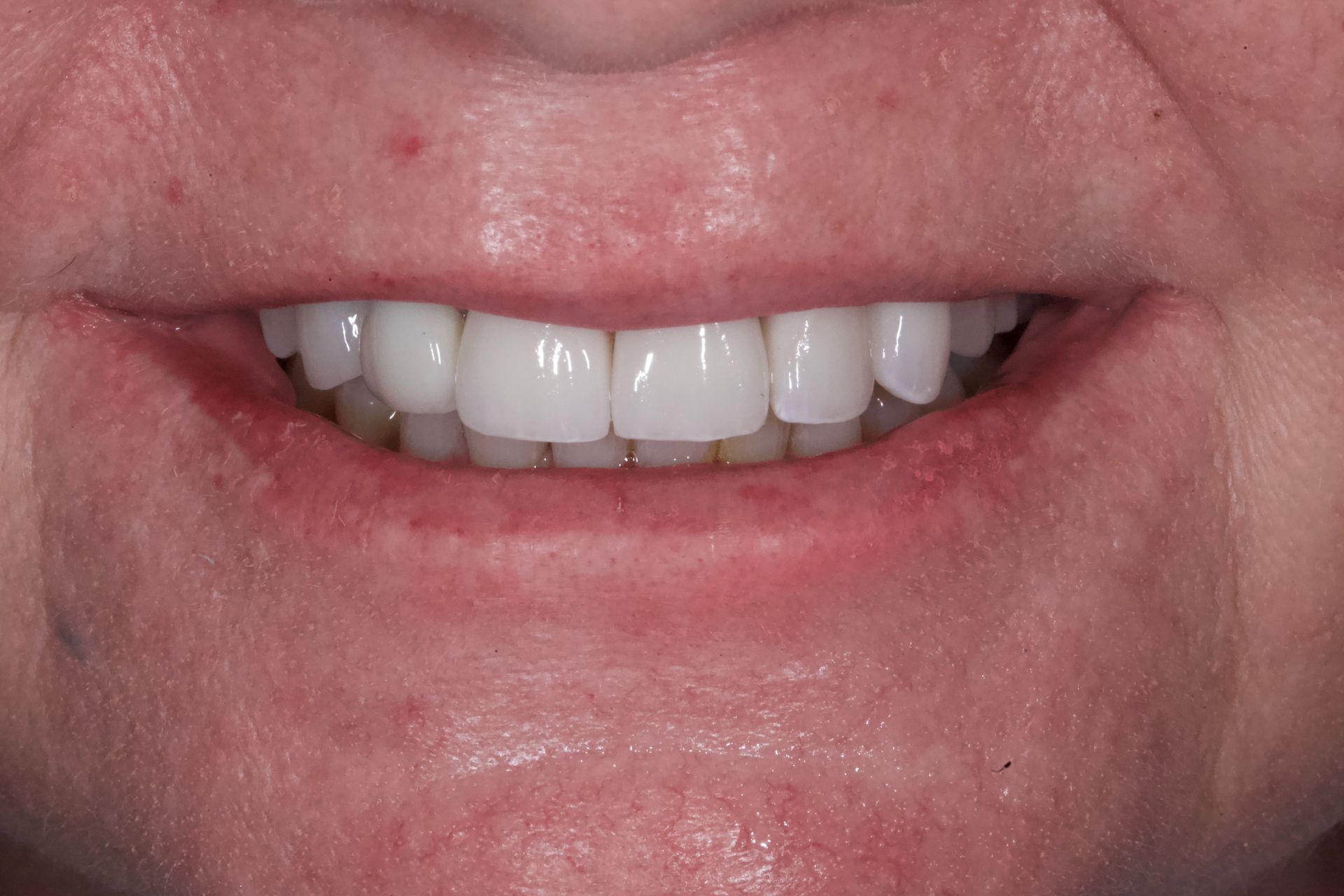Close-up of a smiling mouth showing white teeth with a small dark tooth on the left side