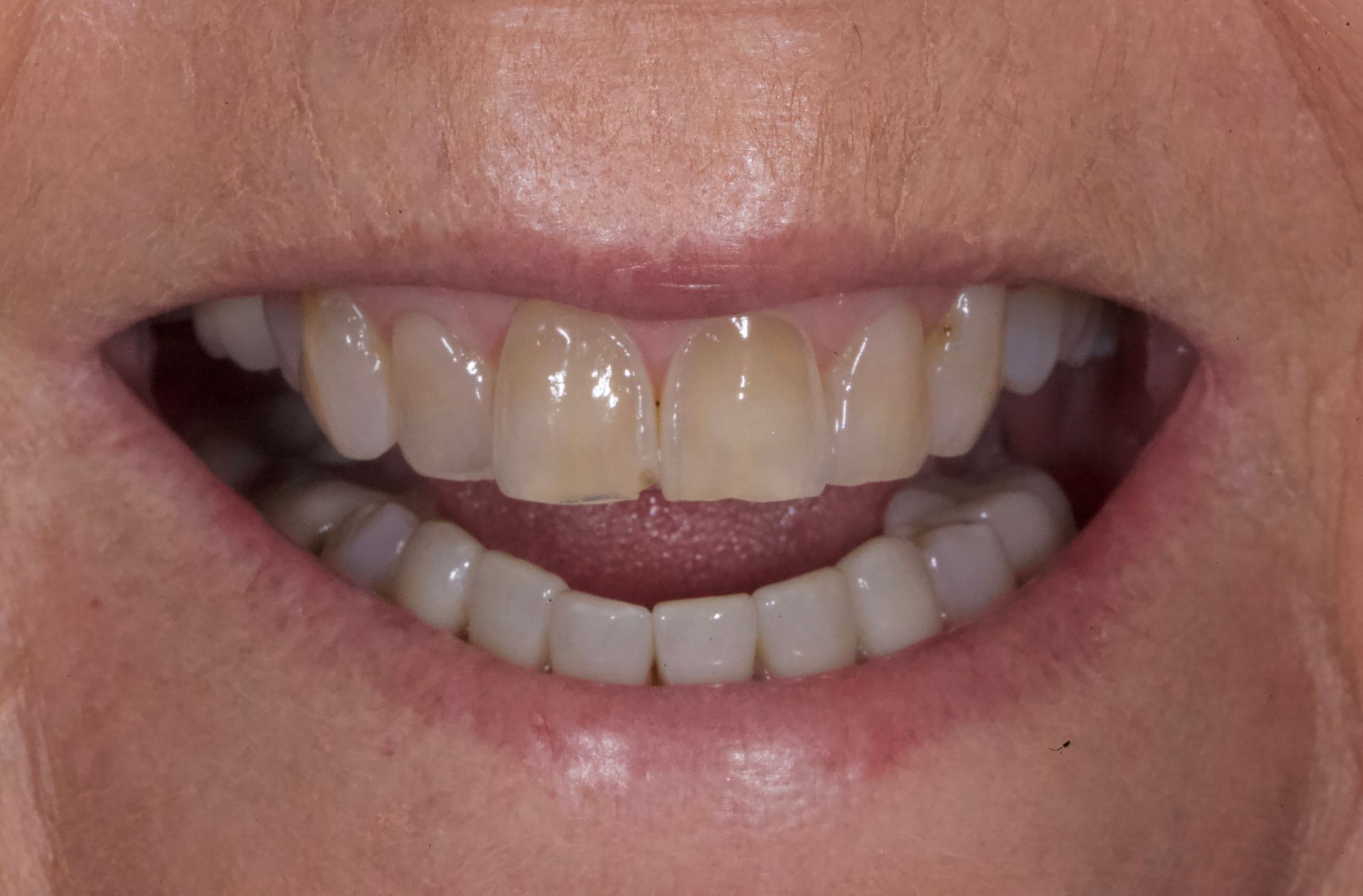 Close-up of a smiling mouth showing upper and lower teeth with a small gap in the front teeth
