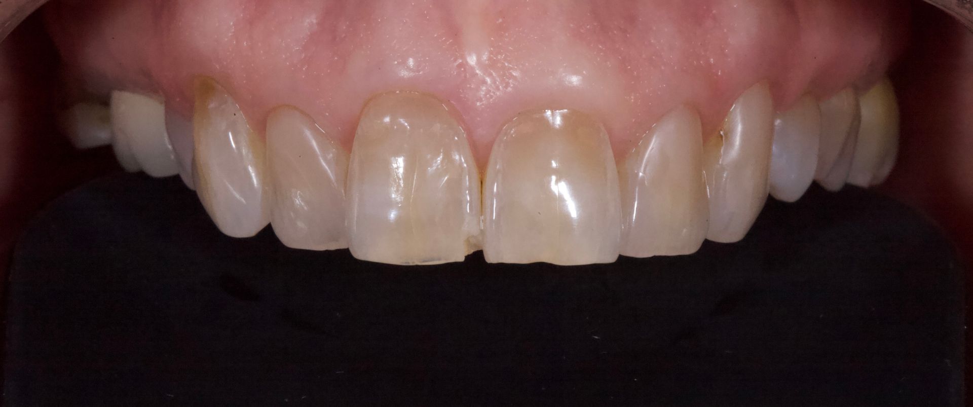Close-up of upper front teeth and gums, showing slightly crooked, yellowed teeth.