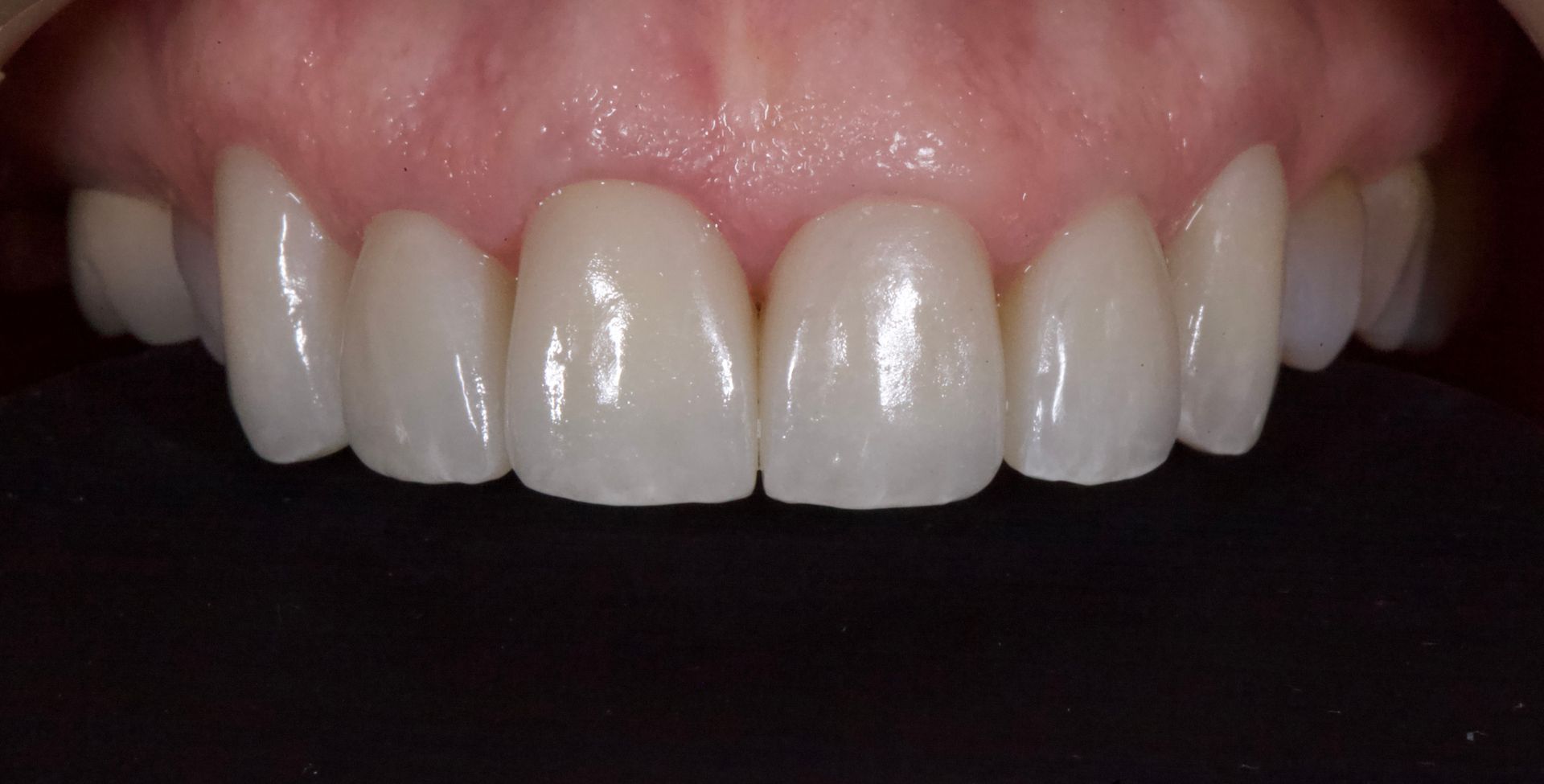 Close-up of smiling mouth with white teeth and pink gums
