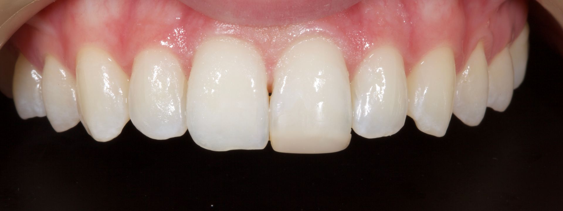Close-up of a smiling mouth with straight white teeth and pink gums