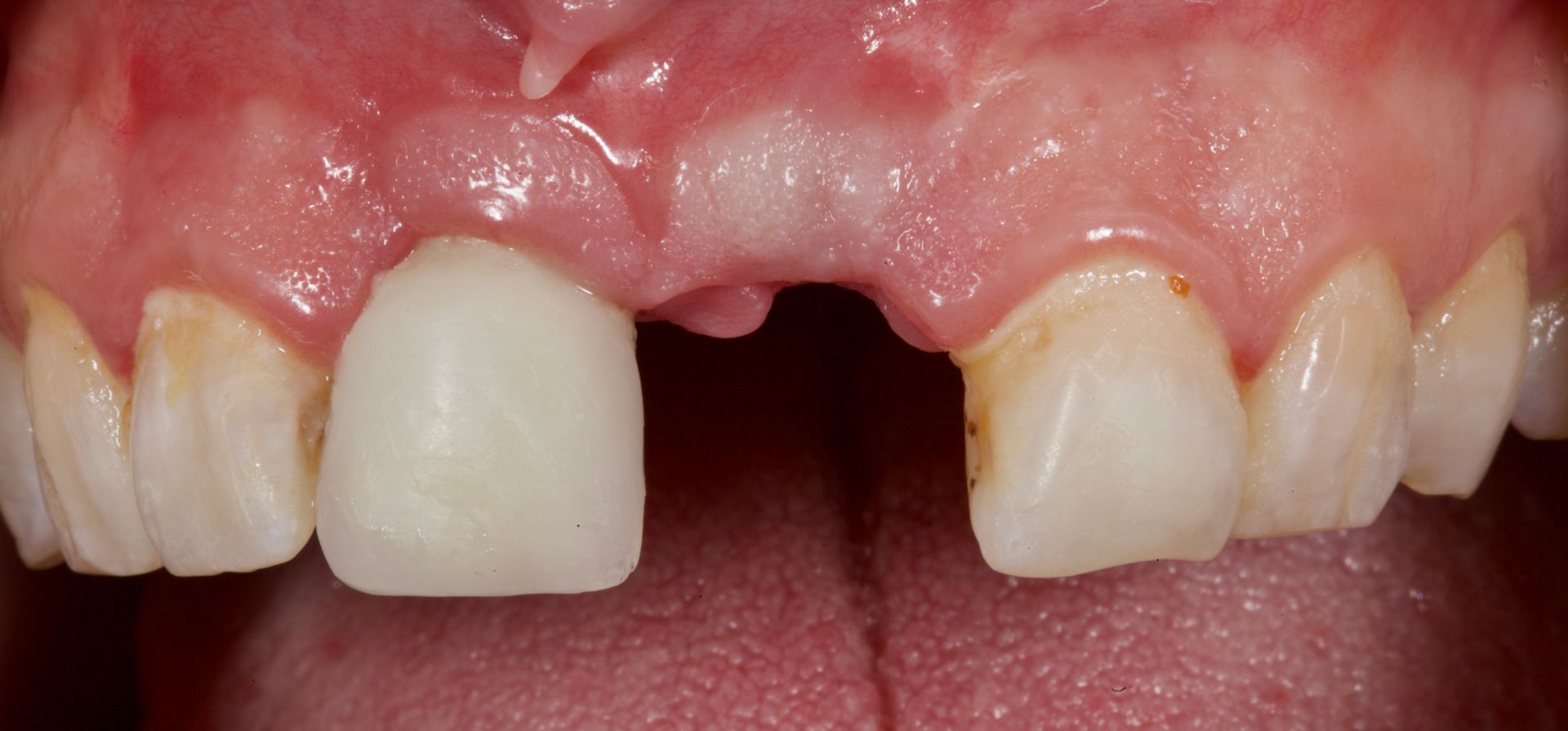 Close-up of upper front teeth with a missing central tooth and a white dental crown on one tooth