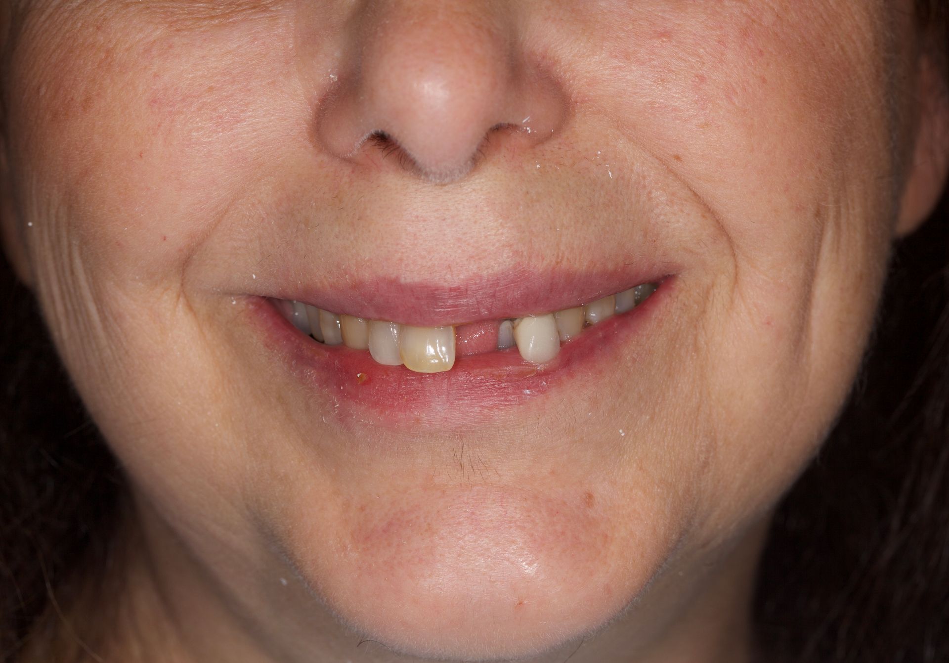 Close-up of a smiling mouth with a missing front tooth and a visible gap in the teeth