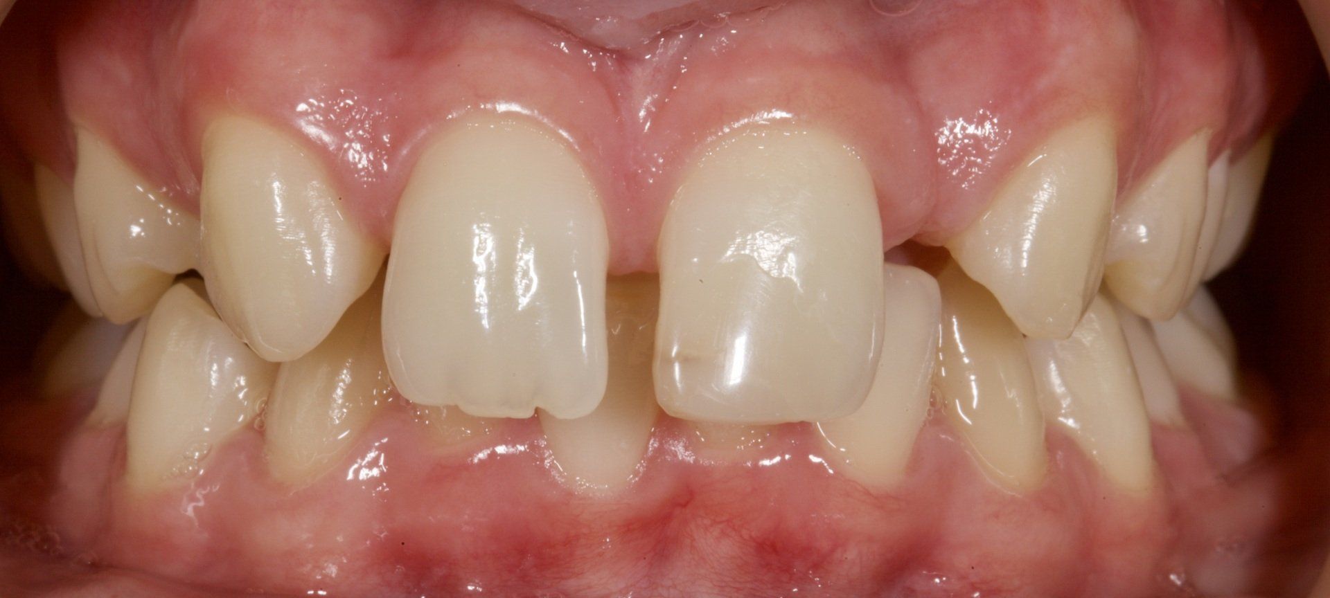 Close-up of teeth with noticeable spacing and overlapping front teeth, framed by pink gums