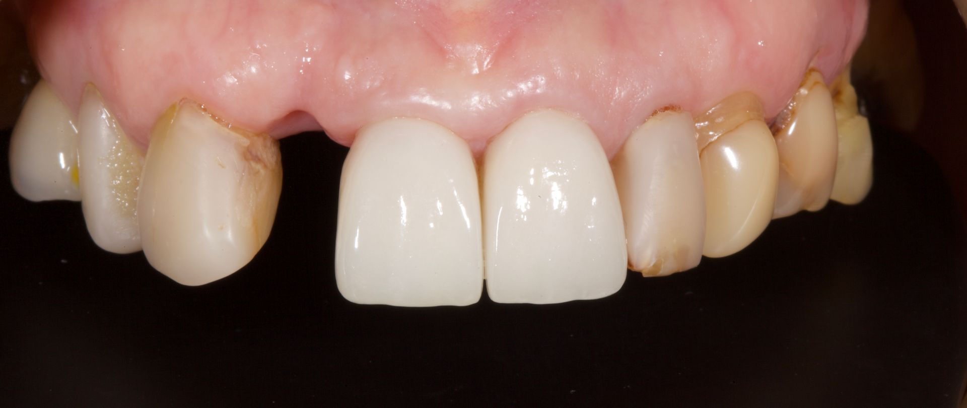 Close-up of teeth with discolored natural teeth and two bright white front crowns