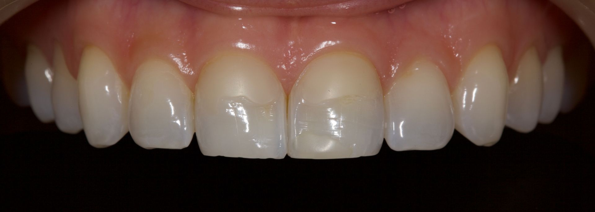 Close-up of smiling mouth showing upper front teeth with a small gap between the two front teeth