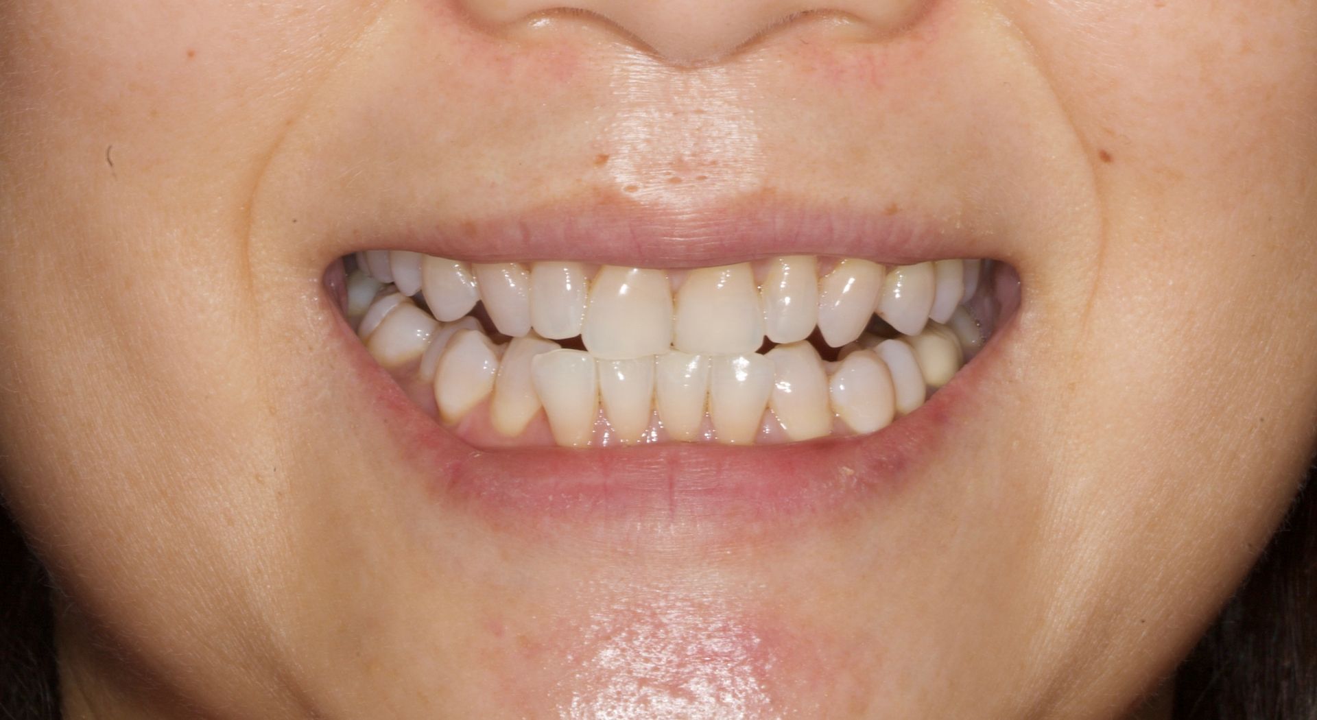 Close-up of a smiling mouth with crowded teeth and visible misalignment