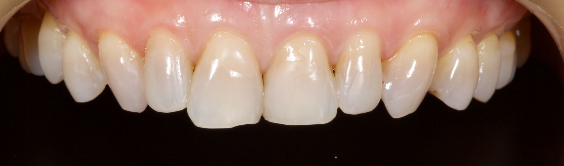 Close-up of smiling mouth showing upper teeth and pink gums