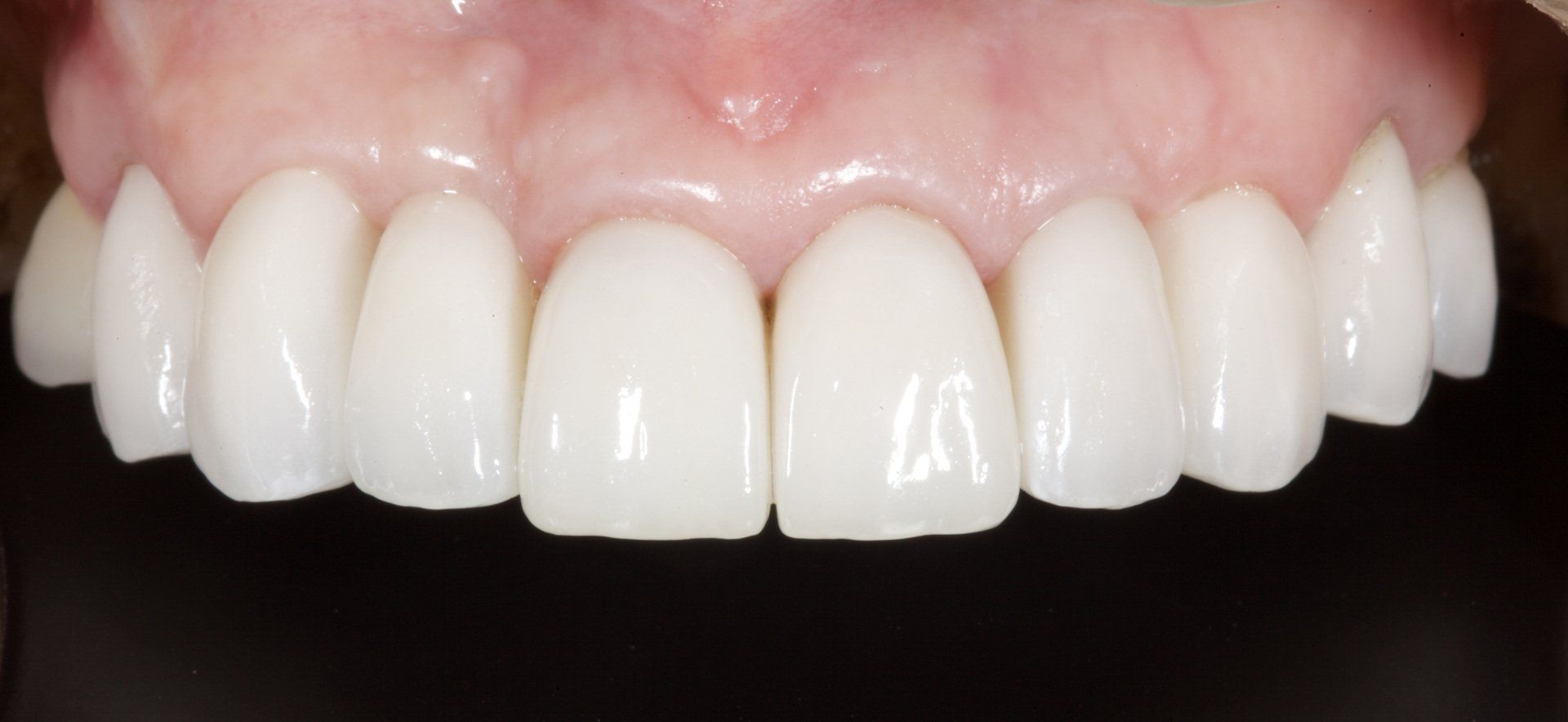 Close-up of a person’s smiling mouth showing white teeth and pink gums