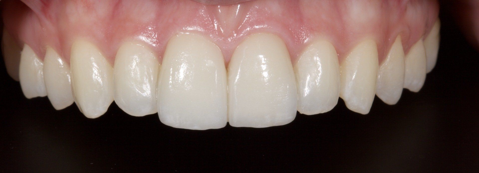 Close-up of a smiling mouth with white teeth and pink gums