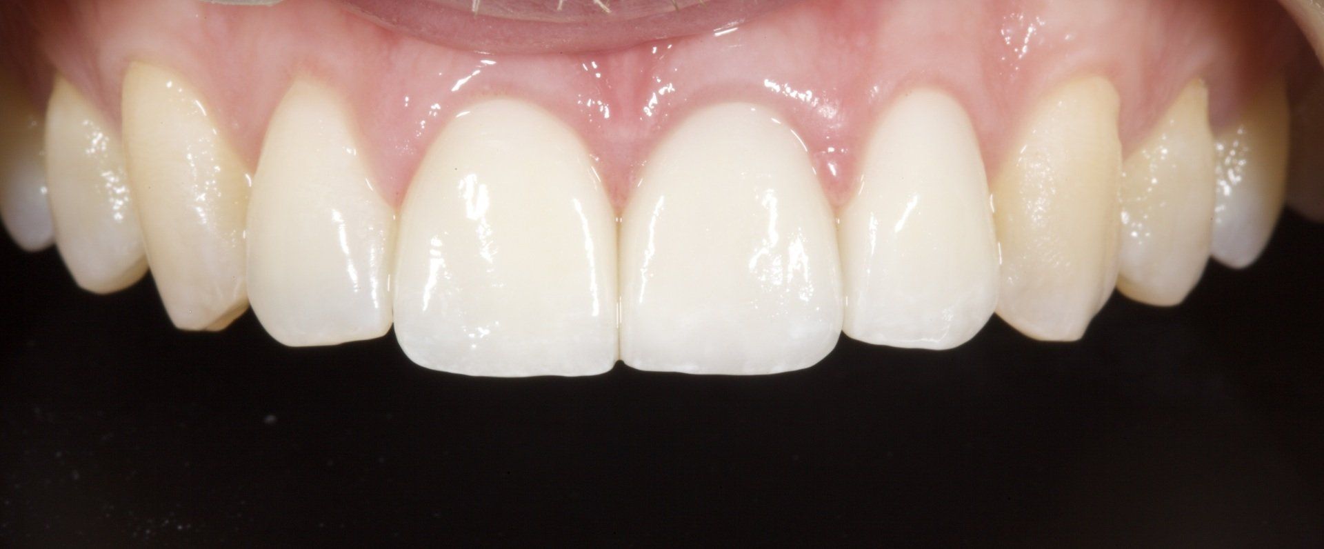 Close-up of a smile showing upper front teeth and pink gums