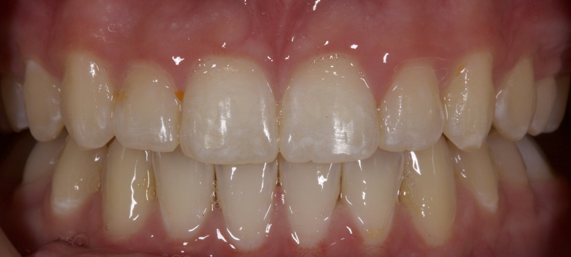 Close-up of a person’s teeth and gums with a bright white smile