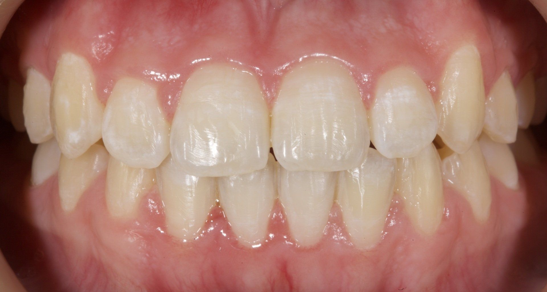 Close-up of a person's teeth and gums showing a front smile with slight tooth crowding