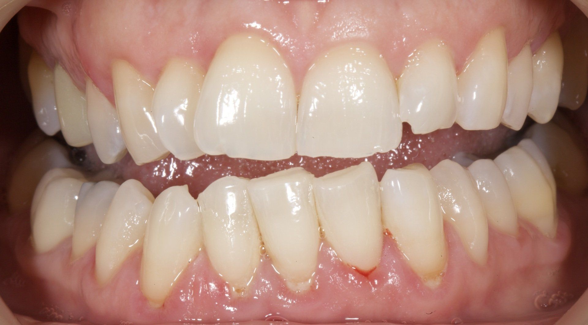 Close-up of a person’s teeth with a visible gap between the upper front teeth.