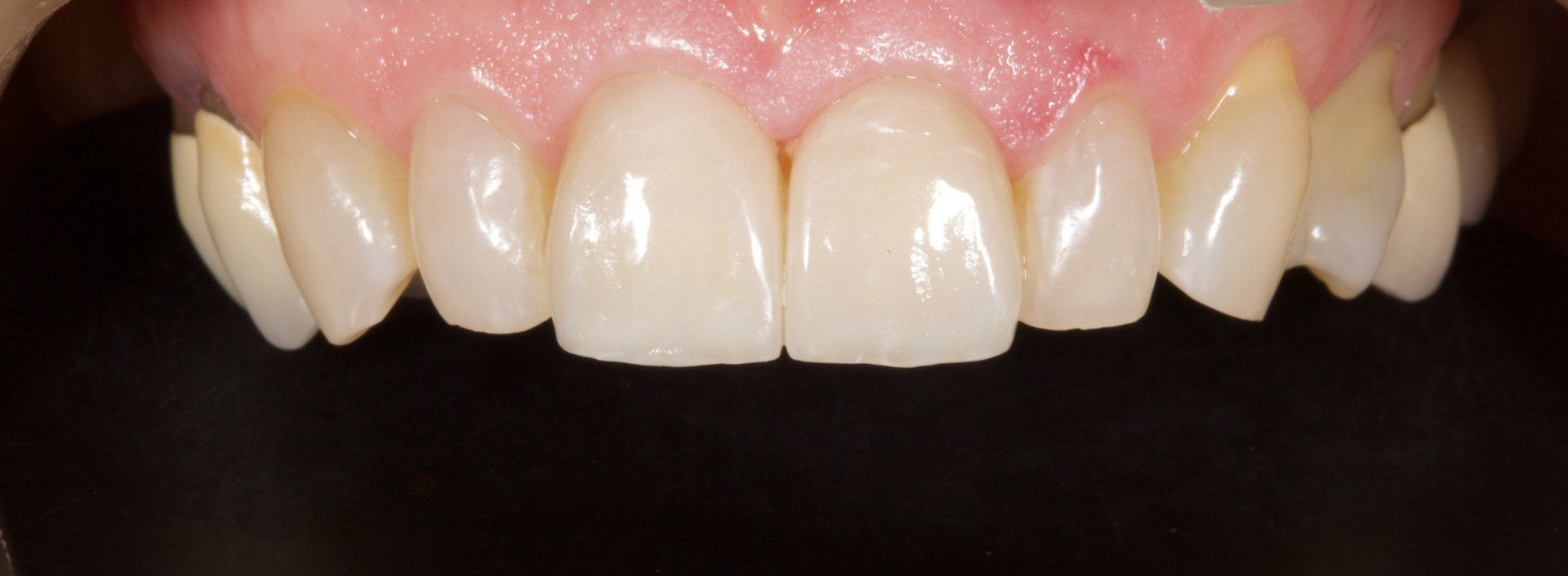 Close-up of upper front teeth with slightly yellowed enamel and pink gums