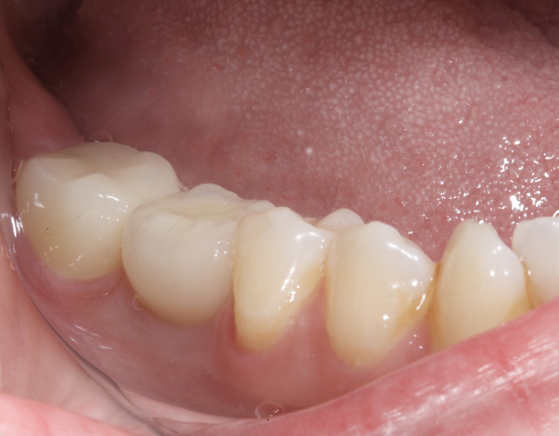 Close-up of lower teeth and gums, showing a small gap and slight tooth misalignment.