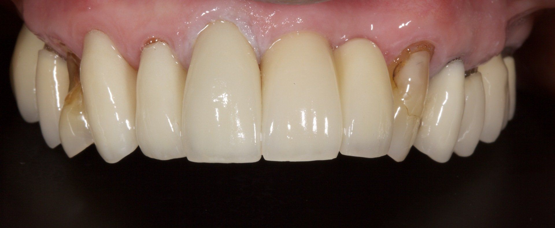Close-up of upper front teeth with slight discoloration and pink gums