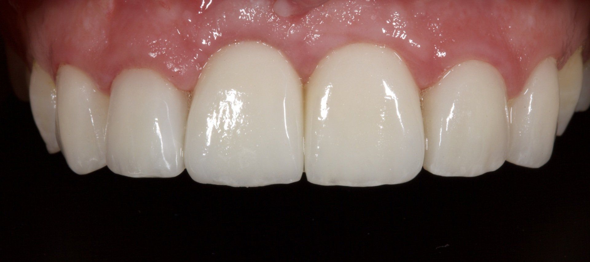 Close-up of a person's white upper teeth and pink gums, showing a bright smile