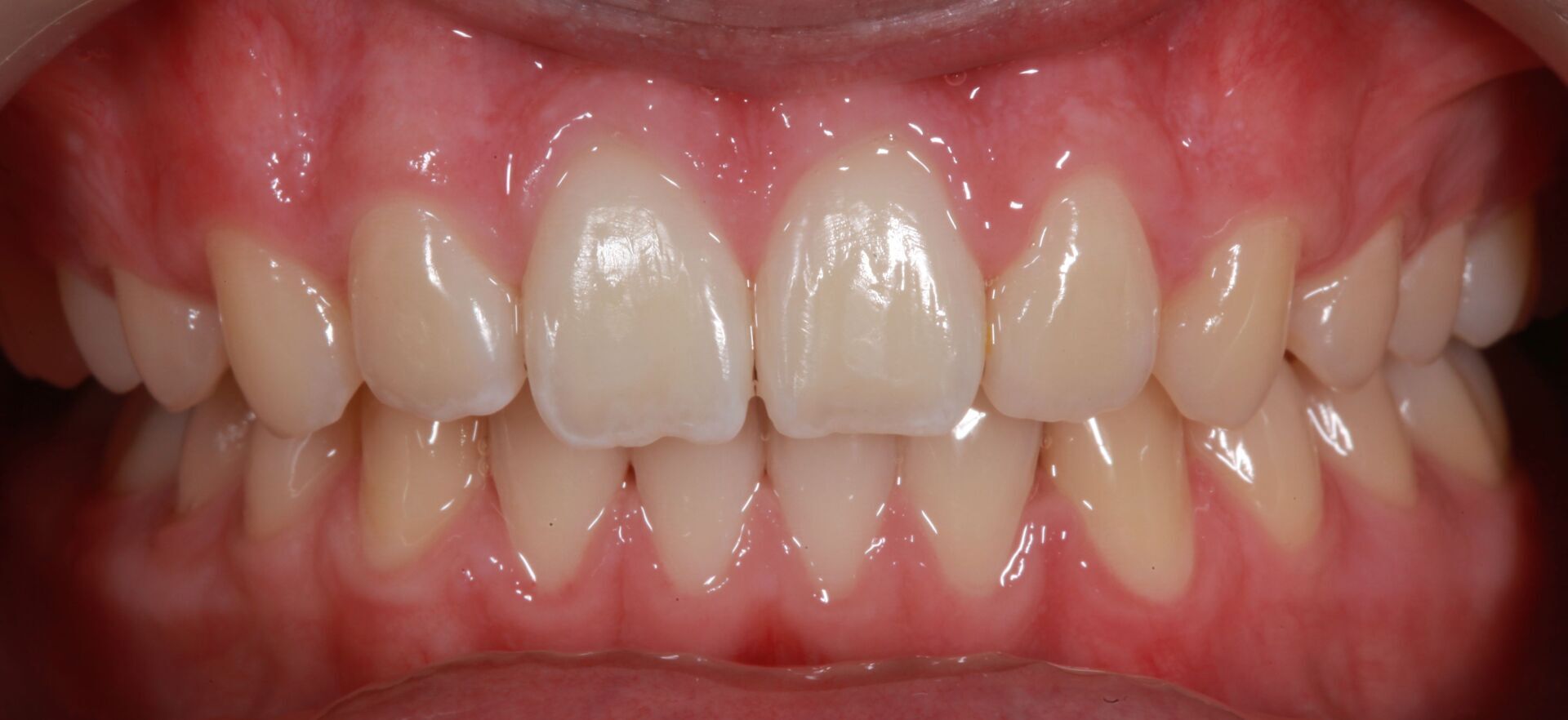 Close-up of a smiling mouth showing straight white teeth and pink gums