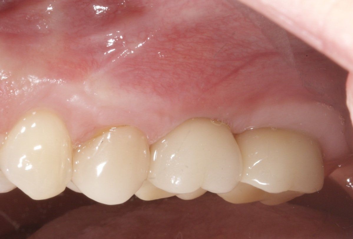 Close-up of upper front teeth and pink gums inside a mouth