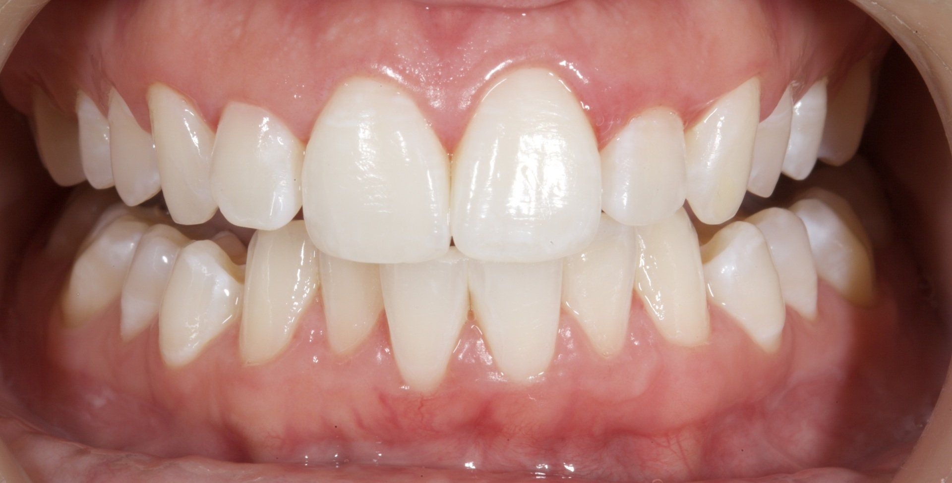 Close-up of a smiling mouth with white teeth and pink gums