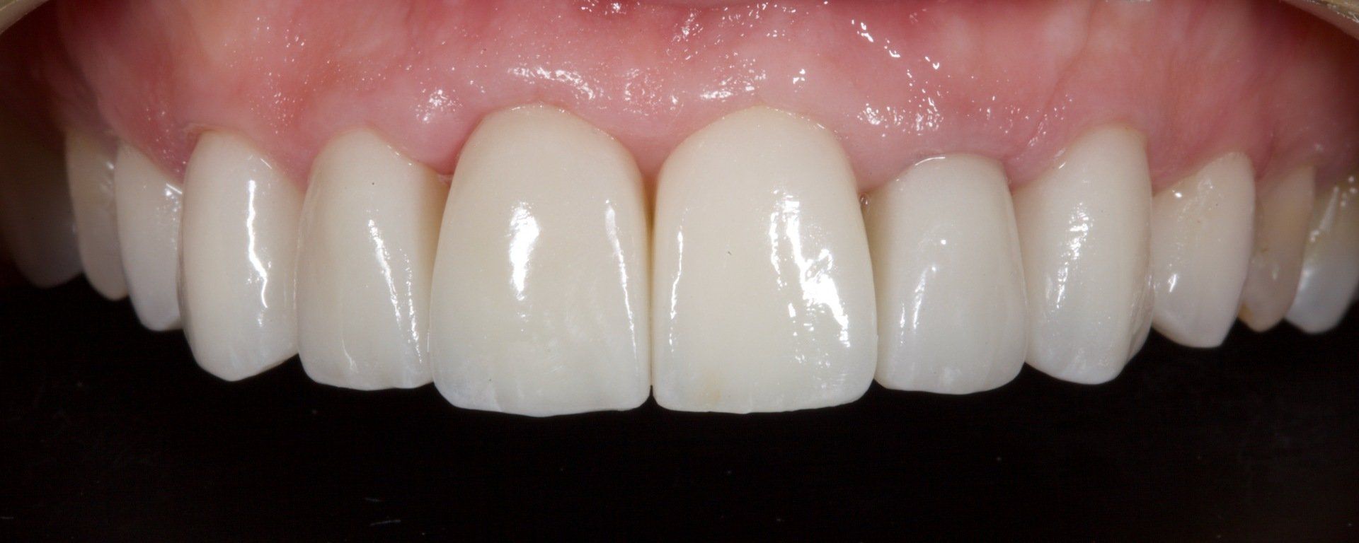 Close-up of a smiling mouth with straight white teeth and pink gums