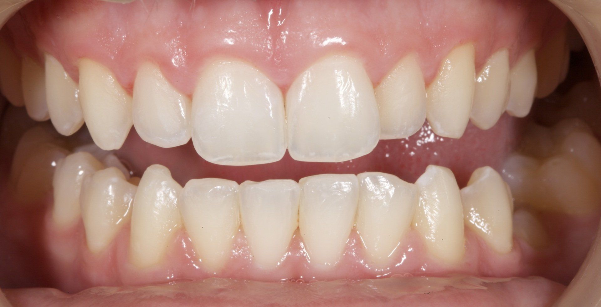 Close-up of smiling mouth showing upper and lower front teeth and gums