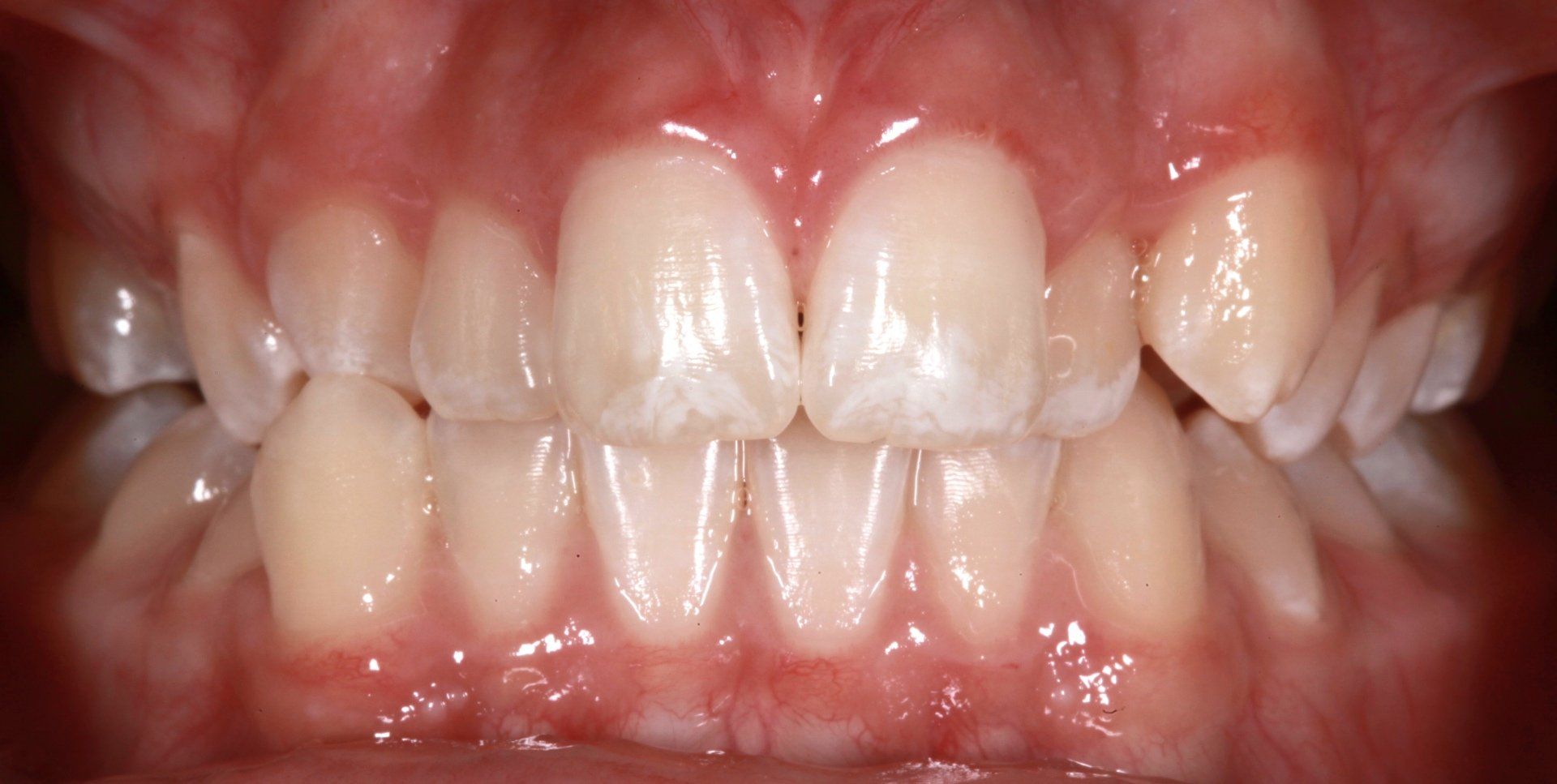Close-up of a person’s teeth and gums with braces on the upper front teeth.