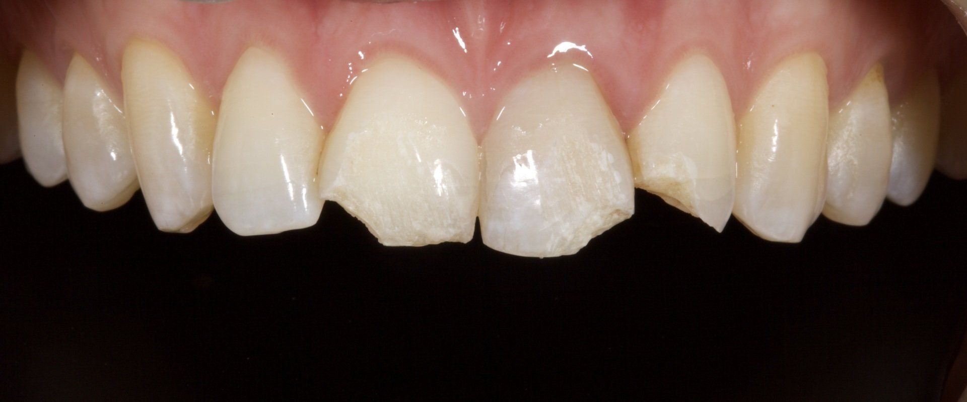 Close-up of front teeth with a chipped central incisor and uneven enamel.