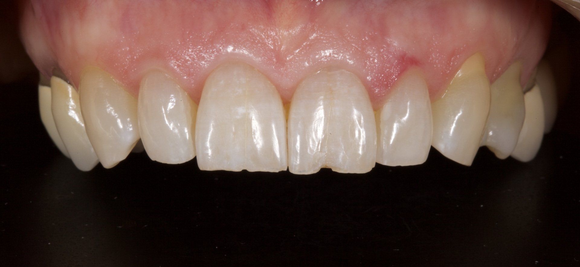 Close-up of upper front teeth and gums, showing slightly irregular alignment