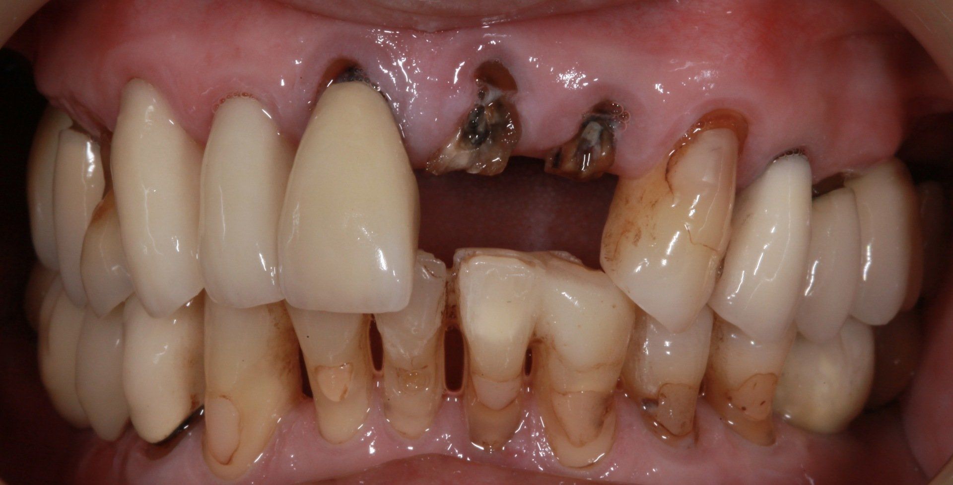 Close-up of badly damaged teeth with severe decay, gaps, and dark stains in the upper gums.
