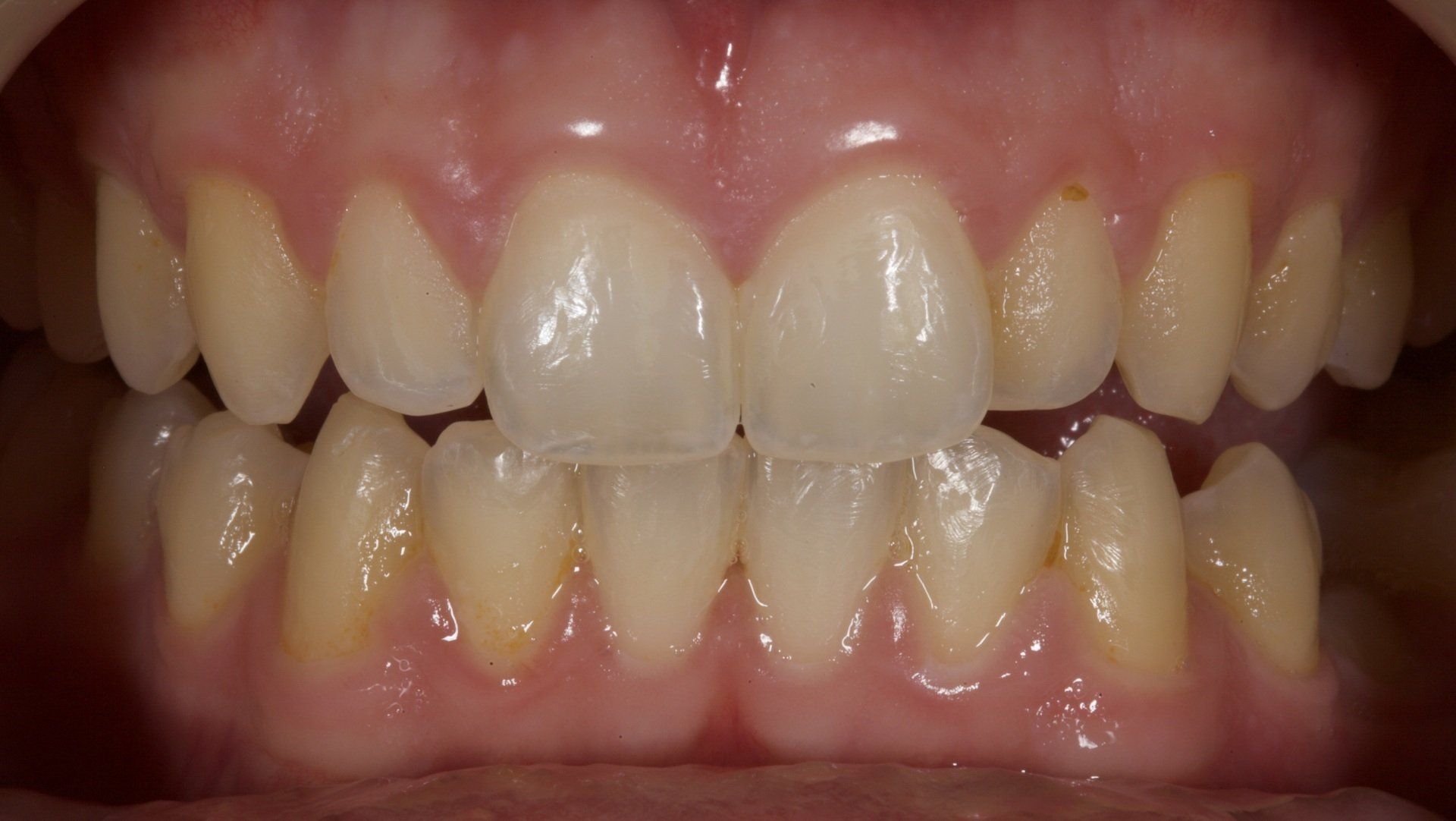 Close-up of human teeth with a clear orthodontic retainer, showing upper and lower front teeth.